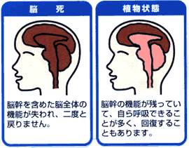 脳死と植物状態の違い図